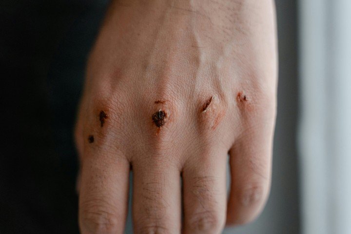 Requiere menos cambios que los apósitos convencionales, lo que reduce los costos de tratamiento y minimiza el riesgo de infecciones.