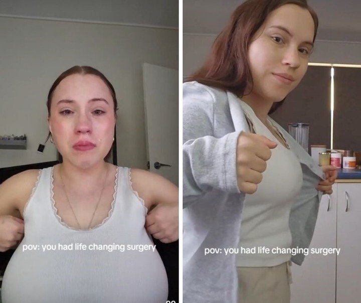 El antes y después de la reducción mamaria. Foto: captura de video/TikTok @amyhills6.