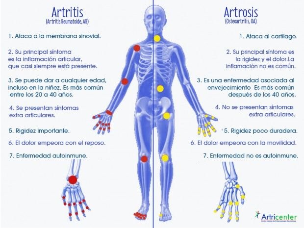 Una premio Nobel reveló el secreto para prevenir la artritis con una simple especia en El Cronista, Información General