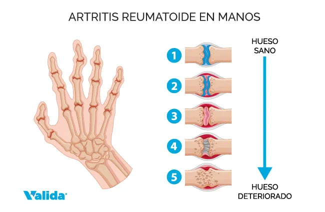 Una premio Nobel reveló el secreto para prevenir la artritis con una simple especia en El Cronista, Información General
