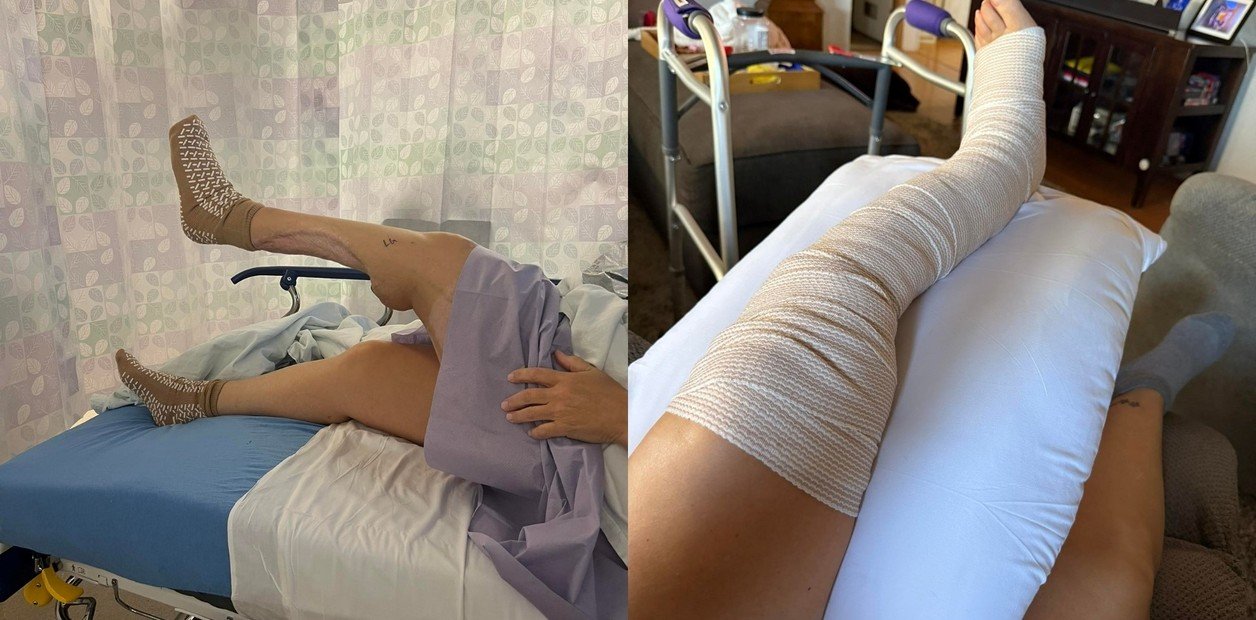 Sullivent se sometió a varias cirugías de injerto de piel y comenzó terapia tras el ataque del tiburón. Foto: Facebook.