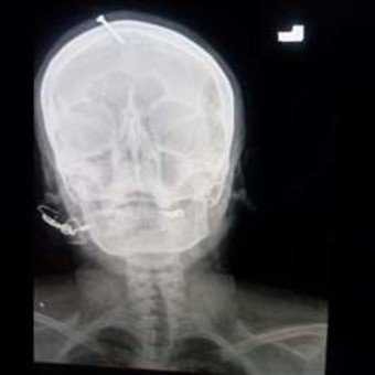 Para que "tuviera un varón", un curandero le clavó un clavo en la cabeza a una embarazada 