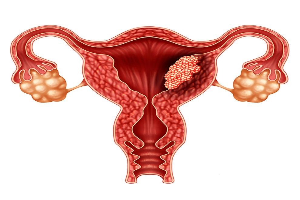 Cáncer de útero en El Cronista, Información General