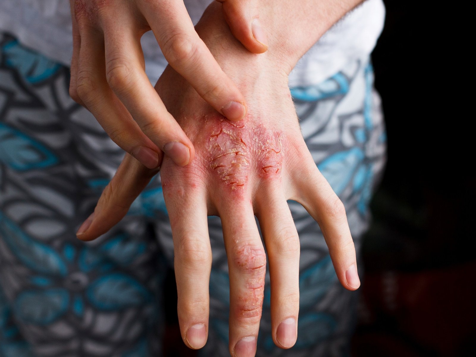 La psoriasis es un problema global grave.