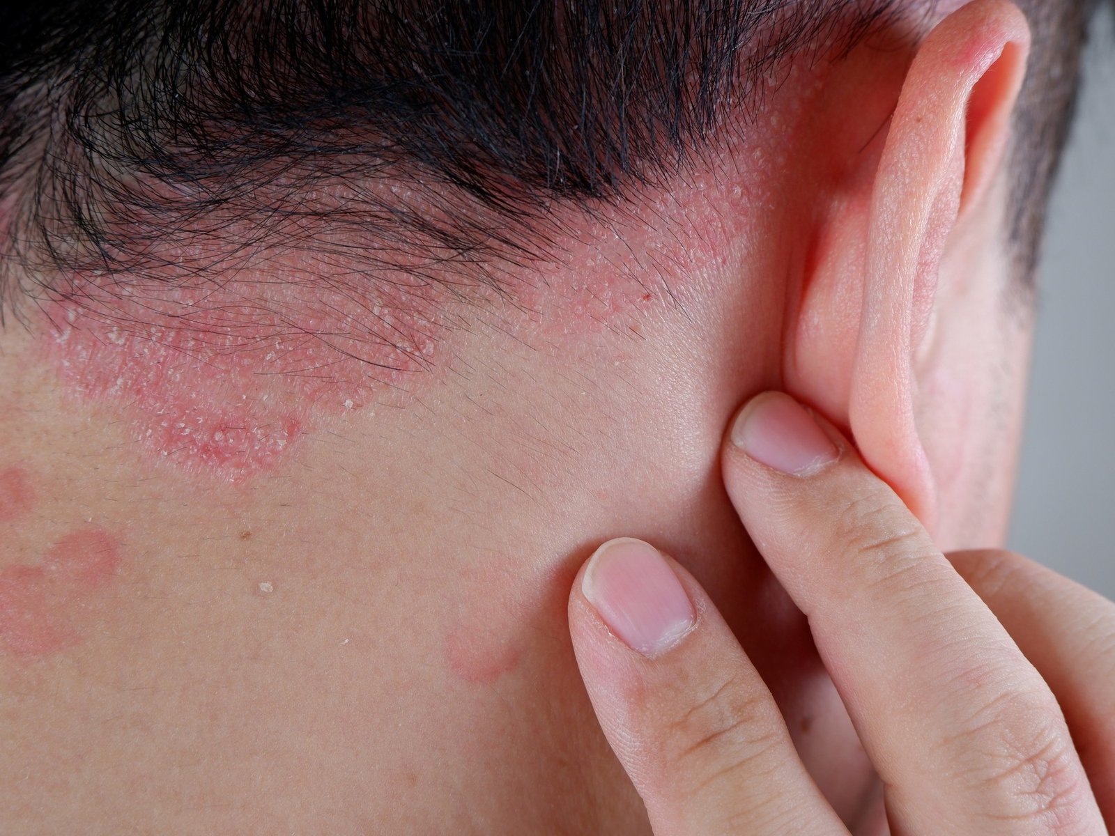Entendiendo la psoriasis: una lucha personal y colectiva La psoriasis es mucho más que una simple afección cutánea; es u... Descubre más sobre comunicación, ...