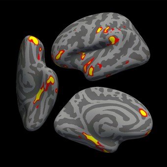 Identifican una particular atrofia del cerebro en la gente que tuvo Covid leve y no estaba vacunada